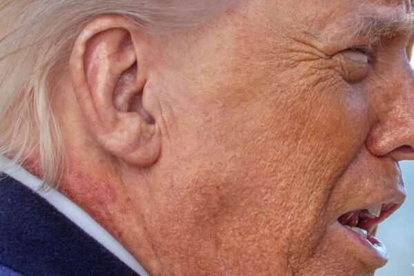 WTF is wrong with Trump’s neck?