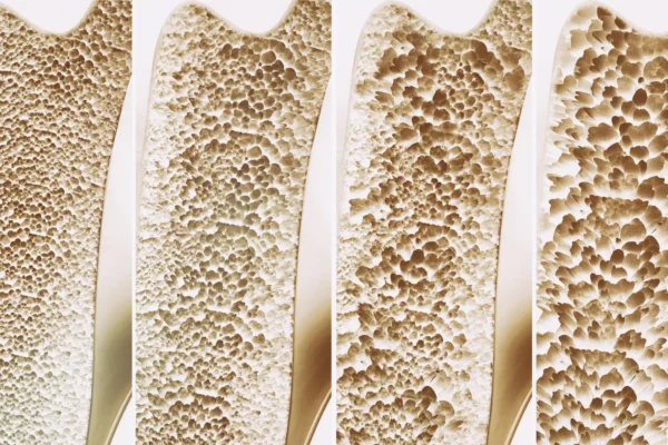 Millions take calcium and vitamin D for stronger bones. A major review finds little benefit
