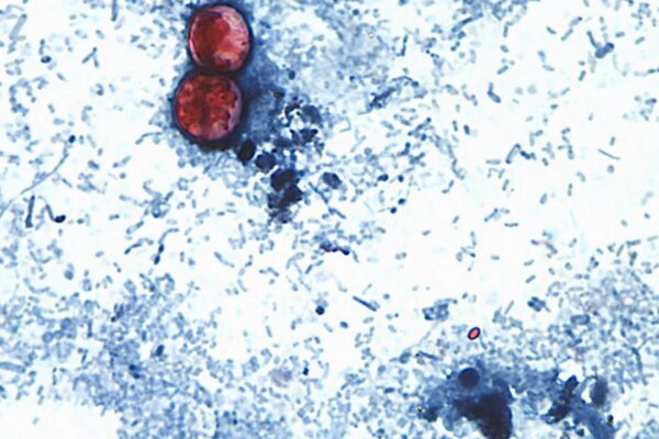 US announces first two deaths from cyclospora outbreak